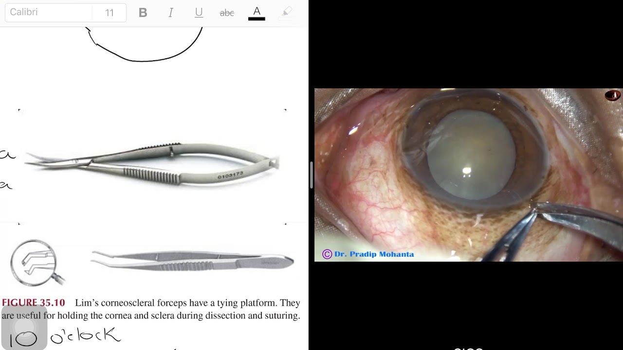 Small Incision Cataract Surgery - Manual (Step-by-Step) - YouTube