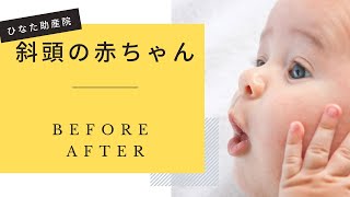 斜頭の赤ちゃん〜Before After〜