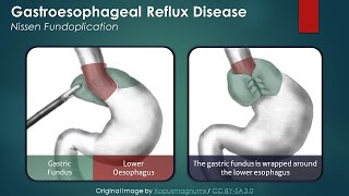 Gastroesophageal Reflux Disease (GERD): Nissen Fundoplication