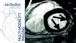 Cardiomyopathies I: Complementary Roles of Echo & CMR (M.Quiñones, MD; D.Shah, MD) January 26, 2021