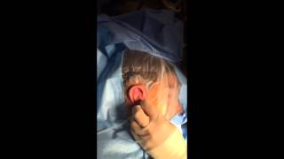 Dr  Bonilla Microtia Suction