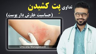 تداوی پت کشیدن (حساسیت خارشدار پوست)| داکتر قیس نیکزاد