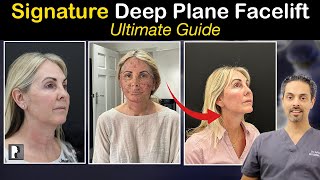 Considering a Facelift? EVERYTHING you need to know! - The Ultimate Facelift Guide