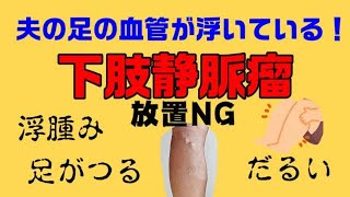 【夫が下肢静脈瘤の疑い】足の血管が浮き出ている人は要注意！診断方法