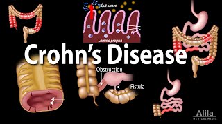 Crohn's Disease: Pathophysiology, Symptoms, Risk factors, Diagnosis and Treatments, Animation.