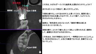 根管治療はヤバイヨ