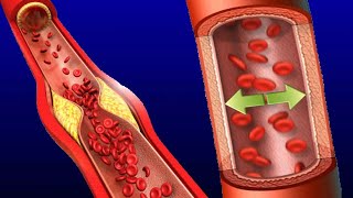 Is There A Link Between Hypertension And Hyperlipidemia?