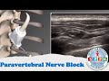 Paravertebral Nerve Block