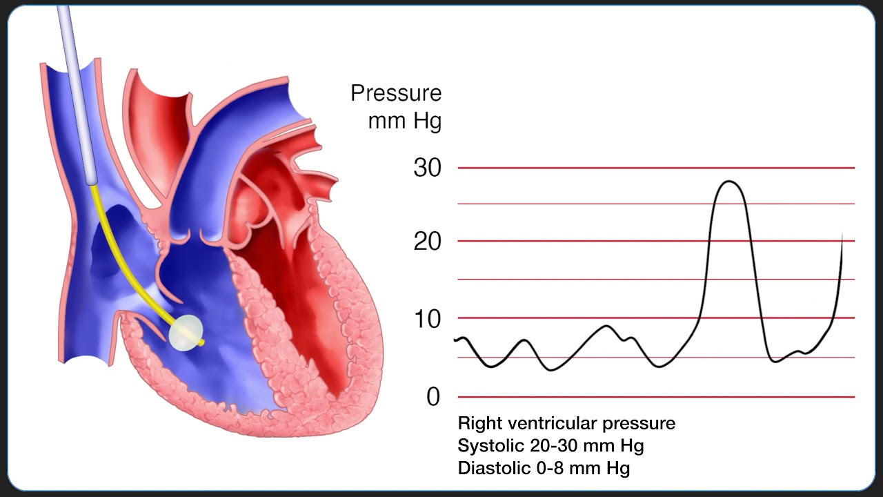 Insertion Of A Pulmonary Artery (Swan-Ganz) Catheter - YouTube