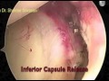 adhesive capsulitis frozen shoulder arthroscopic release dr. shekhar srivastav orthopedics