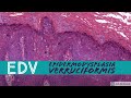 Epidermodysplasia Verruciformis (EDV): 5-Minute Pathology Pearls