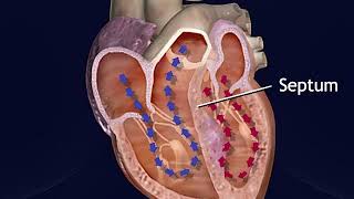 Hypertrophic Obstructive Cardiomyopathy Animation - Treatment Procedure for HOCM Video