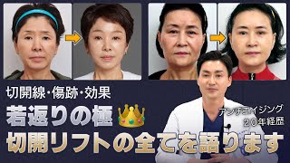 「切開線・傷跡・効果」 若返りの極り👑切開リフトの全てを語ります  【Aging L】