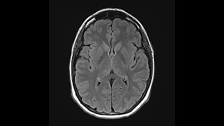 Brain Cancer Prediction System with streamlit Web App
