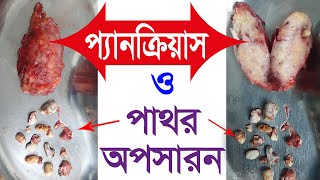 প্যানক্রিয়াসের জটিল অপারেশন।