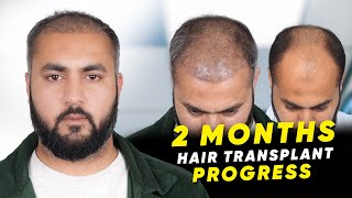 Hair Transplant in Jodhpur | Best Results \u0026 Cost of Hair Transplant in Jodhpur