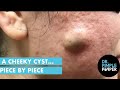 A Cheeky Cyst... Piece by Piece