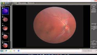 How to Use Optomed Smartscope Viewer Software