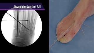 Innovation in Foot Care: Paragon 28's MIS Lapidus Nail Procedure