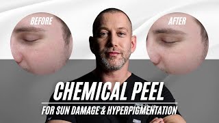 Chemical Peel for Sun Damage and Hyperpigmentation | RevePeel TCA PHENOL MIX | Dr. Jason Emer