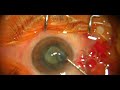 phaco for grade 2 NS cataract #phaco #cataract