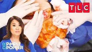 Most Extreme Pops From Season 9 Part One | Dr. Pimple Popper | TLC