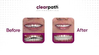 Straighten Your Teeth with ClearPath Aligners | A Simple Solution for Malocclusion #aligners