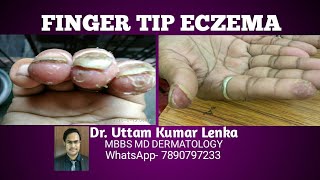 Fingertip eczema(skin peeling from tip of fingers/ उँगलियों के नोक से त्वचा फटना)(Anguthi Fatiha)