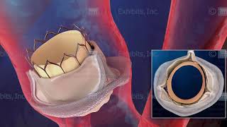 Showing Alternative Views with Medical Animation - Placement of a Replacement Aortic Valve