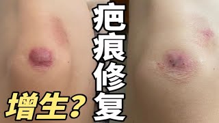 疤痕修复？！天气热了总难免磕磕碰碰！