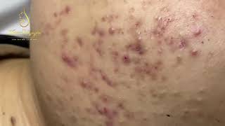 Blackheads removal (324) | Loan Nguyen