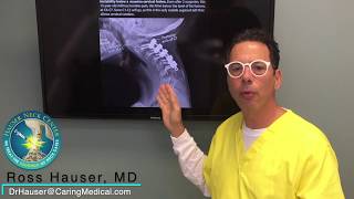 Avoiding cervical fusion for spinal instability