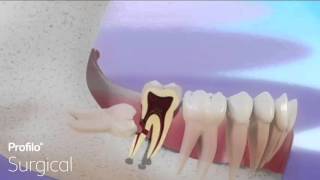 Impacted Wisdom Teeth