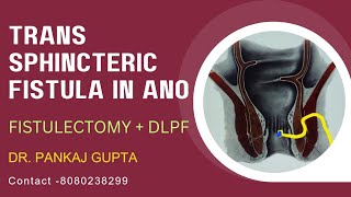 Trans sphincteric complex Fistula in ano managed by DLPF + Fistulectomy| Dr.Pankaj Gupta,Akola.