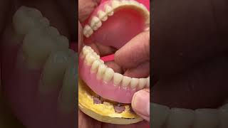 Overdenture with Mini Implants