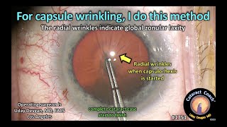 CataractCoach™1751: for capsule wrinkling, I do this method