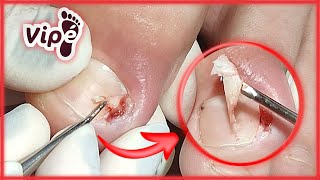 NAIL INFECTION SOLUTION  (OVERGROWN INFECTED INGROWN TOENAIL REMOVAL)