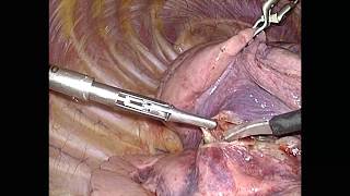 Asvide: Example of exposure achieved by use of throw-off lung forceps