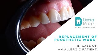 Replacement of prosthetic work in case of an allergic patient. 🦷