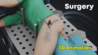 SuperPath Hip Replacement (Surgery) : 3D Animation