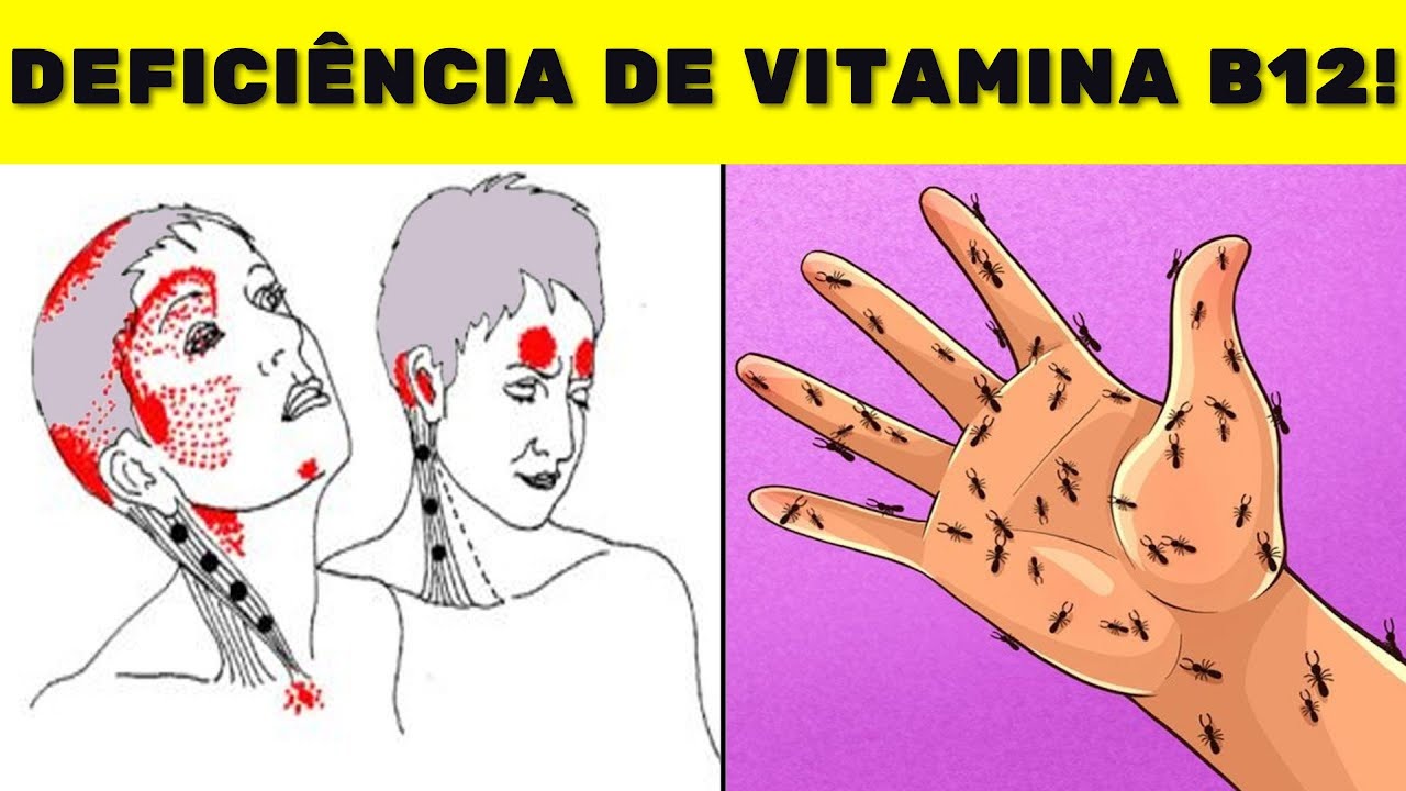 Sintomas De Deficiência De Vitamina B12 Que Nunca Devem Ser Ignorados ...