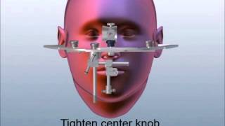 How to Transfer the Whip Mix Facebow from Patient to Articulator