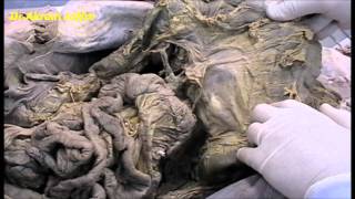 Anatomy of the large intestine - dissection