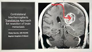 Contralateral Inter-hemispheric Trans-falcine approach to the brain tumor