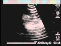 Endobronchial Ultrasound (EBUS) Biopsy of Mediastinal Lymph Nodes 2