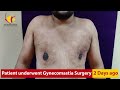 gynecomastia surgery results man boobs surgery in bangalore venkat center