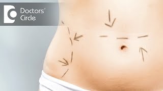 Is Laser Liposuction better than Conventional Liposuction? - Dr. Surindher D S A