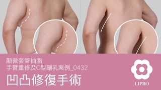 凹凸修復手術｜顯微套管抽脂｜手臂重修及C型副乳案例_0432