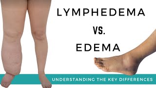 Lymphedema VS. Edema