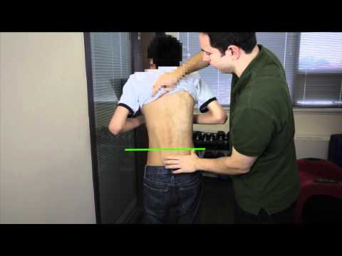 Check if your kids have Scoliosis under 2 minutes! Check if your kids have Scoliosis under 2 minutes!